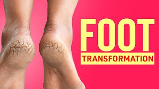 ULTIMATE Routine For Cracked, Tanned Feet!