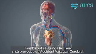 Tratament fibrilație atrială | Implantare dispozitiv Watchman |  ARES |