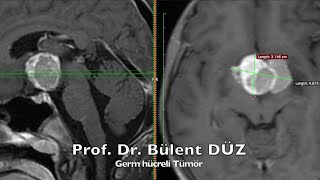 3. ventrikül içi Germ Hücreli Tümör  Prof. Dr. Bülent DÜZ