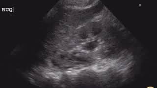 Mild Hydronephrosis from an Ureteral Stone