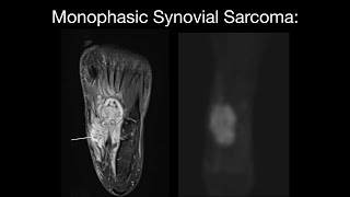 Monophasic Synovial Sarcoma