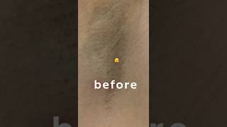 Before and after laser hair removal #shorts