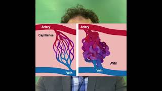 مقدمة عن و وصف مبسط للتشوه الشرياني الوريدي بالمخ | Brain AVM