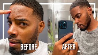 How I Got Rid Of My Forehead Breakout In 3 Days! | Black Mens Skin Care Routine