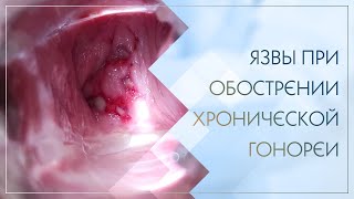 😲 Язвы при обострении хронической гонореи. Клинический случай №69