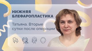 Татьяна. Нижняя блефаропластика. Вторые сутки после операции