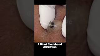 A giant blackhead extraction || stubborn Blackhead removal procedure part-2