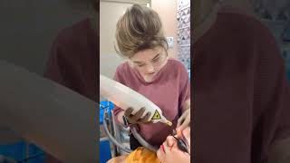 Eyebrows Tatto Removal Treatment by Dr. Asma