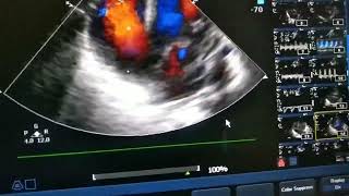 5 chamber view color Doppler demonstrating left ventricular out flow, flow across ASD and TR jet