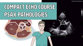 〖Echocardiography〗 Parasternal short axis - Pathologies (PSAX)