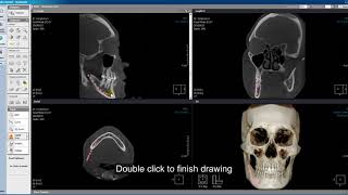 Xelis Dental Case Tutorial Nerve Canal