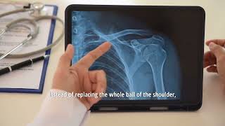 Learn about Shoulder Replacement Surgery with Dr. John Sullivan