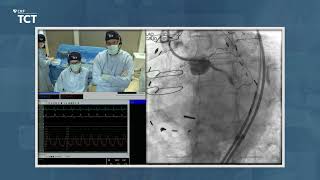 TCT 2021 - Live Retrograde CTO PCI