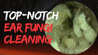 Top-Notch Ear Fungi Cleaning Skill