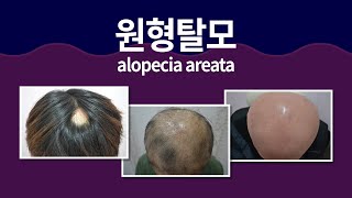 원형탈모(alopecia areata)의 원인 및 치료 / 자가면역질환이란 무엇인가?