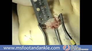 Metatarsal Osteotomy Surgery x264