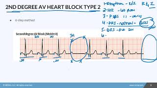 03.13 2nd Degree AV Heart Block Type 2 Mobitz II