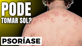 QUEM TEM PSORÍASE PODE TOMAR SOL [DICAS DA ESPECIALISTA]