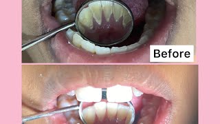 Full Mouth Scaling දත්වල බැදී ඇති මැලියම් ඉවත් කිරීම Britanna Dental Clinic