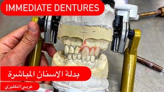 MAKING IMMEDIATE DENTURES/صناعة طقم الاسنان الفوري #waxbae #immediatedentures #surgicaldentures