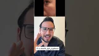 ممنوع حقن الفيلر في المنطقة دي؟! #shorts