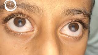 Ophthalmic Signs (Cornea)