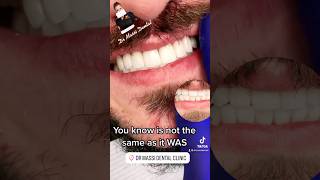 Front teeth veneers , Smile designing