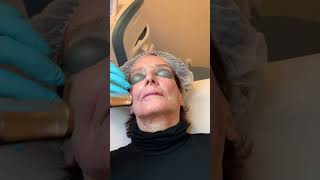 Laser resurfacing treatment #antiaging #collagenproduction #lasertreatment #finelinesandwrinkles