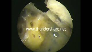 Temporal bone dissection 5 opening the semicircular canals- dr.shreekantha acharya