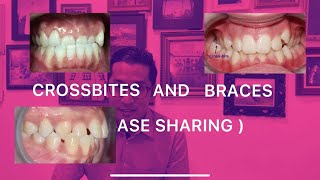 CROSSBITES AND BRACES