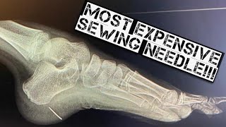 Most EXPENSIVE Sewing Needle in Foot #SurgicalProcedure