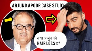 Arjun Kapoor|TRANSPLANT|RECEDING|Hair|Line|HairFall|MINOXIDIL|FINASTERIDE|results|hindi|Celebrity