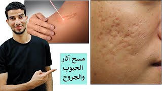 تخلص من ندبات الوجه واثار الحبوب والجروح والحروق في اسرع وقت