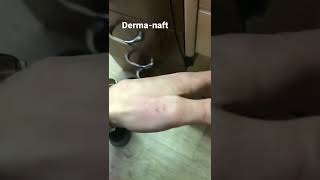 #псориаз #Лечение псориаза , #Derma-naft #naftalanproducts