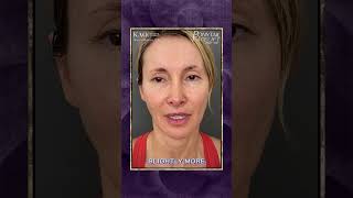 Ponytail Facelift: Pre-Op Surgery Consult Part 1 At Kao Plastic Surgery #facelift #beforeandafter