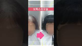 60대 여성 앞머리ㆍ정수리 탈모 보톡스증모술 자신감있는엄마 이제남은인생 나를위해 가꿉니다!