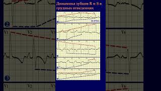 ЭКГ. Динамика R и S в грудных отведениях. #shorts