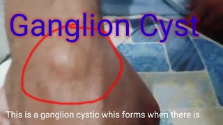 Ganglion Cyst of wrist