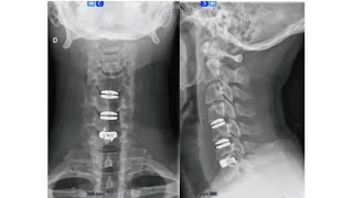 Degenerative Cervical Spine: Diagnosis and Management