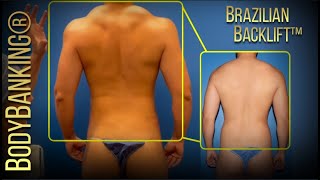 BodyBanking® Brazilian Backlift™ with Male Plastic Surgery Expert