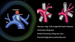 Unveiling the Mystery: Fetal Pulmonary Vascular Ring and the Anomalous Left Pulmonary Artery