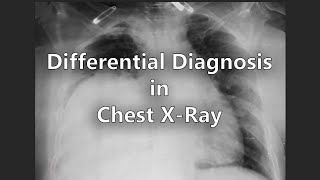 Chest X Ray differential diagnosis for pleural effusion