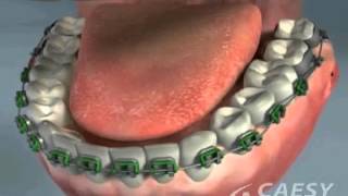 Stabilizzazione occlusione dentale