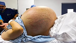 Bauch der 24-Jährigen hörte nicht auf zu wachsen, dann zeigt ein Scan das versteckte 31 Kilo Monster