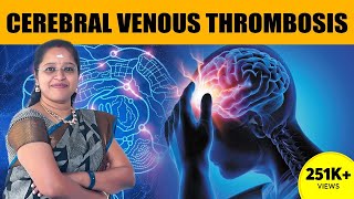 மூளைக்குள் உள்ள அசுத்த இரத்த குழாய் அடைப்பு - CVT in Tamil | Dr. A.Veni | Rockfort Neuro Centre