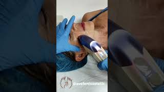 La magia del Hifu12D en el rostro #avefenixestetic