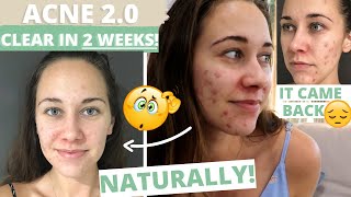 ACNE 2.0 - How to get rid of CYSTIC acne NATURALLY in TWO WEEKS!!!