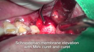 Maxillary Sinus Window approach with drill and INNO fixture installation using S Kit