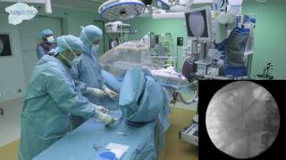 Cystoscopy and Stent Removal