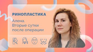 Алёна. Ринопластика. 2 сутки после операции